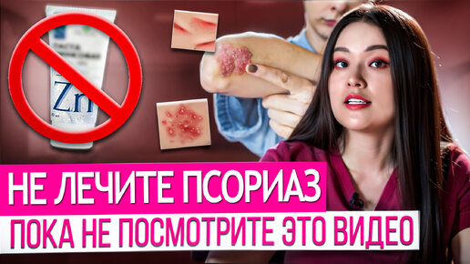 ПСОРИАЗ. Как избежать псориаза? как лечить псориаз?