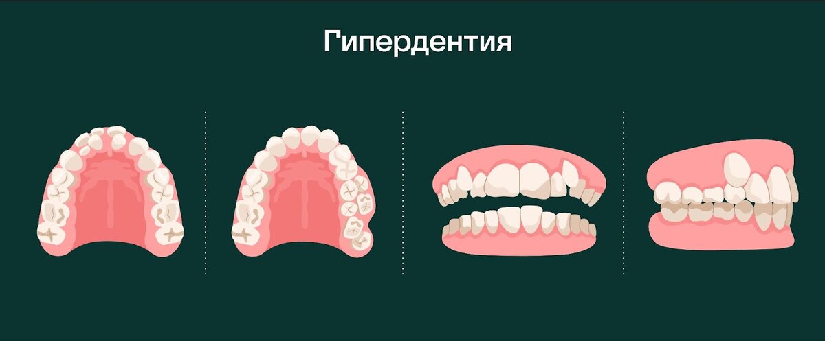 Варианты расположения дистопированных сверхкомплектных зубов