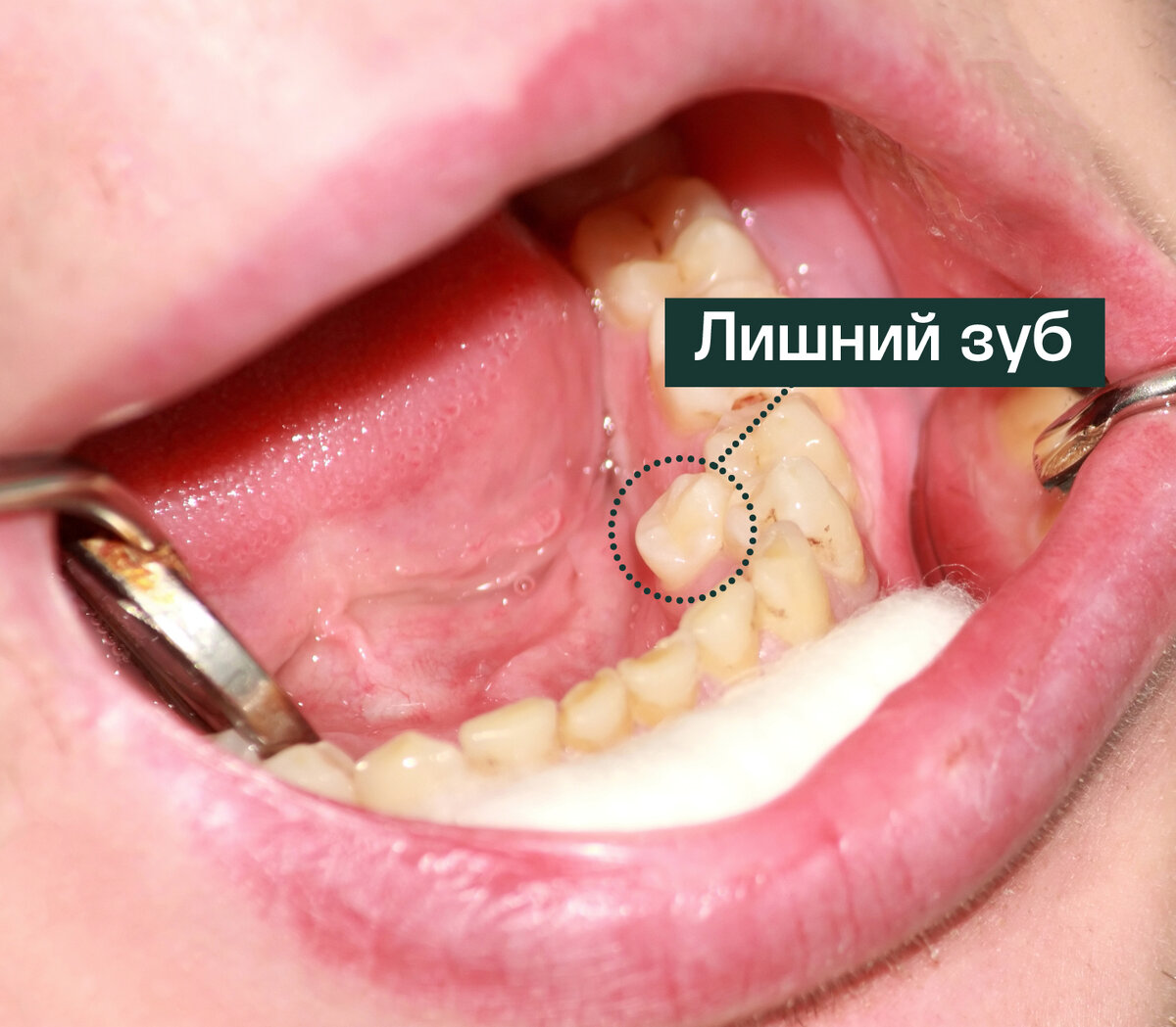 Фото сверхкомплектного зуба, прорезавшегося в области клыка с внутренней стороны зубного ряда