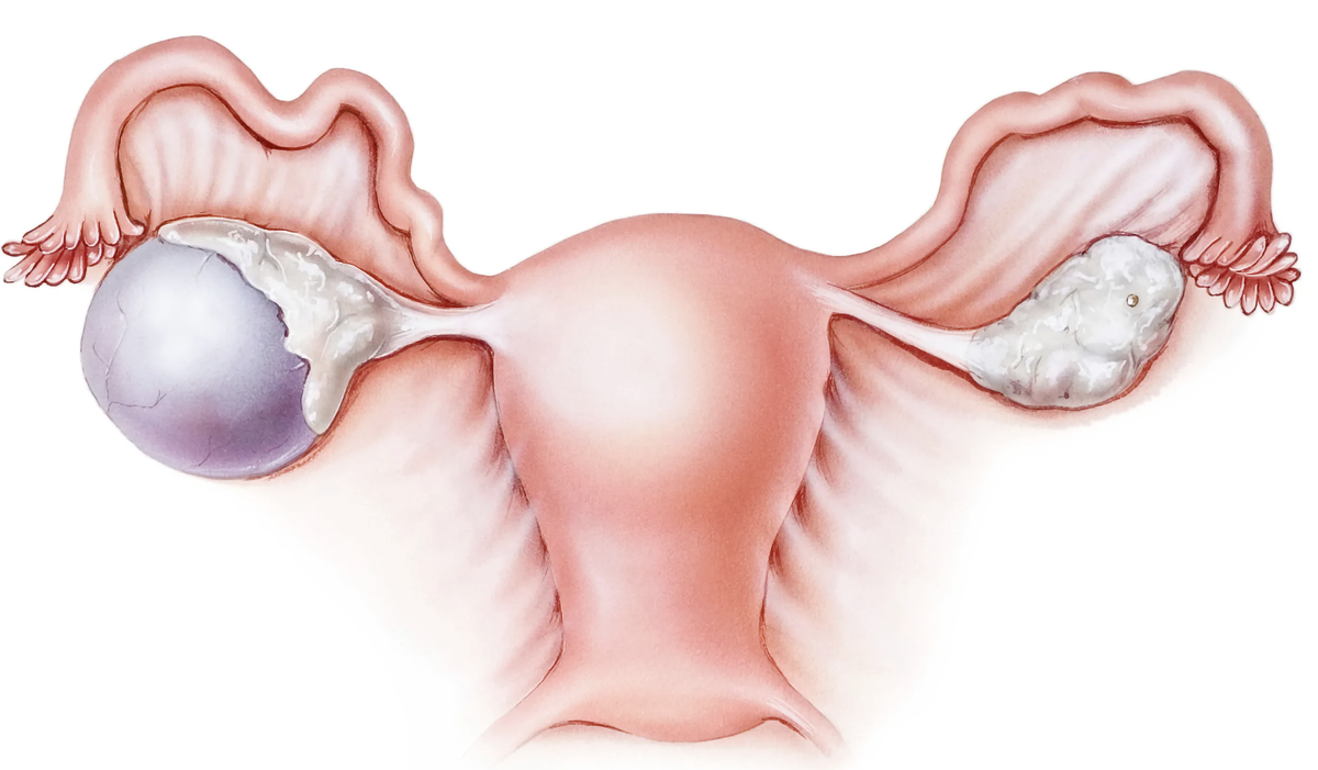 Кисты яичников. С какими кистами откладываем старт программы ЭКО и почему?  | Мать и дитя Савёловская | Дзен