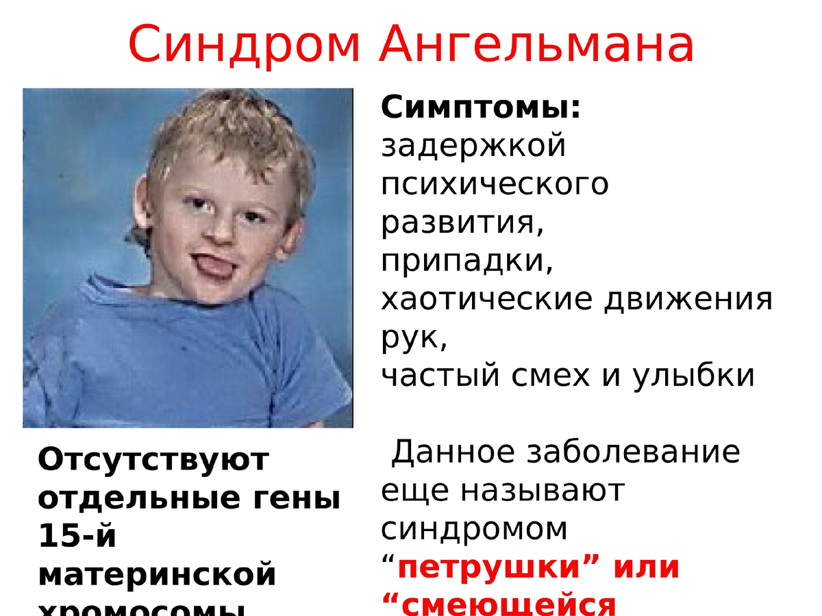 Синдром сладера. Синдром петрушки диагноз у ребенка. Синдром Ангельмана у детей. Люди с синдромом Ангельмана