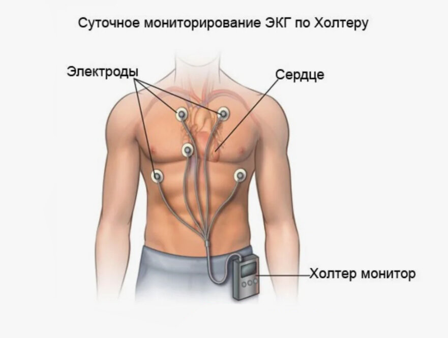 Отклеился холтер что делать