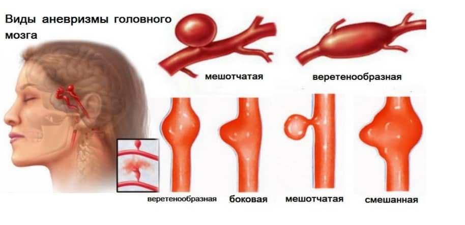  Аневризма сосуда мозга - это опасность, которая подстерегает каждого человека.  Аневризма (по-гречески - «расширение, растяжение») - выпячивание стенки кровеносного сосуда (артерии).-2