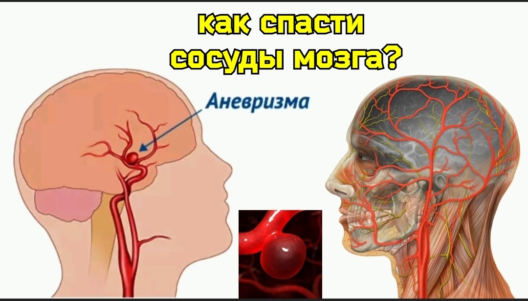  Аневризма сосуда мозга - это опасность, которая подстерегает каждого человека.  Аневризма (по-гречески - «расширение, растяжение») - выпячивание стенки кровеносного сосуда (артерии).