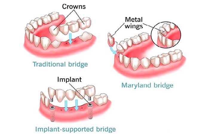 Зубные мосты. Зубной мост против имплантата: Что лучше?