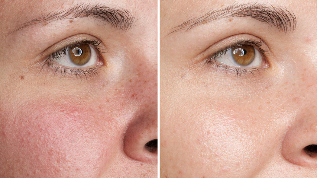 Уход для кожи с покраснениями: Ампулы с Бета Глюканом, Нейро Успокаивающий крем Neuro Sensitive Cellular и Ферментный Пилинг-Бальзам Refine Cellular. Результат применения через 28 дней.