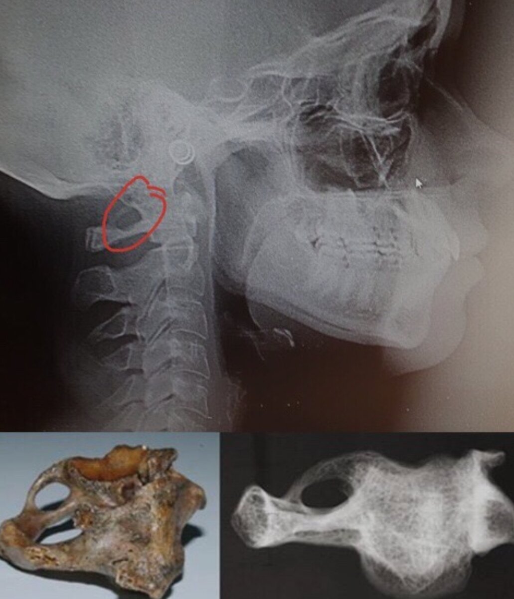  Аномалия Киммерли — это специфическое костное кольцо, которое окружает позвоночную артерию, проходящую через первый шейный позвонок. Оно может быть полным или неполным.-4