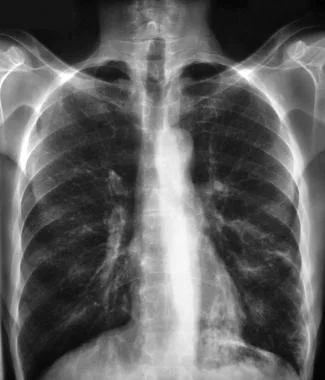 Легкие, сплошь заросшие аспергиллом.