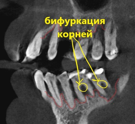 Бифуркация корней - зона, в которой зуб разделяется на ДВА корня