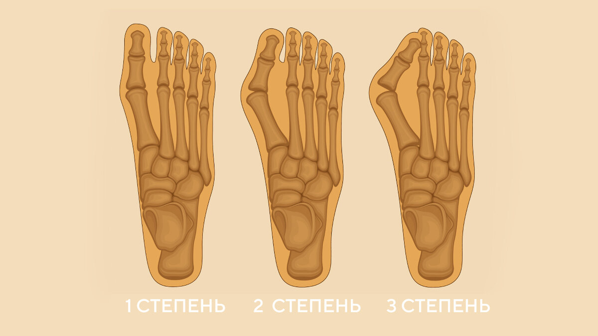 Халюс вальгус: причины появления, способы лечения и меры профилактики |  ТЕЛЕКАНАЛ ДОКТОР | Дзен