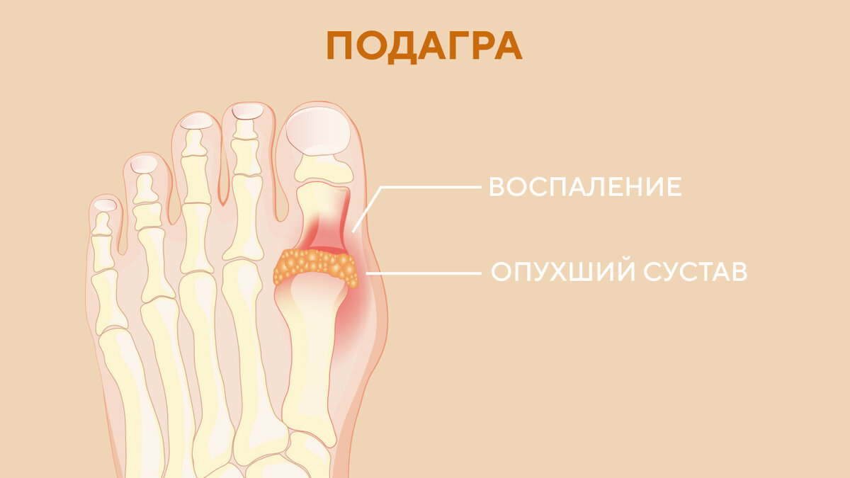 Халюс вальгус: причины появления, способы лечения и меры профилактики |  ТЕЛЕКАНАЛ ДОКТОР | Дзен