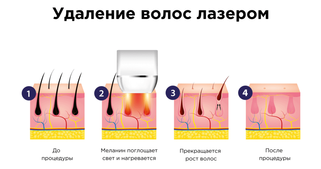 Принцип работы аппарата для лазерной эпиляции