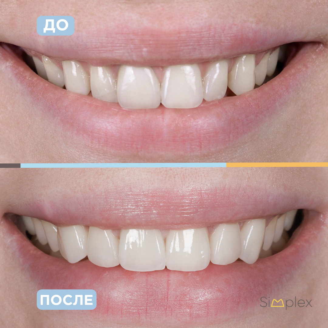 На фото после 6 керамических реставраций в верхнем переднем отделе