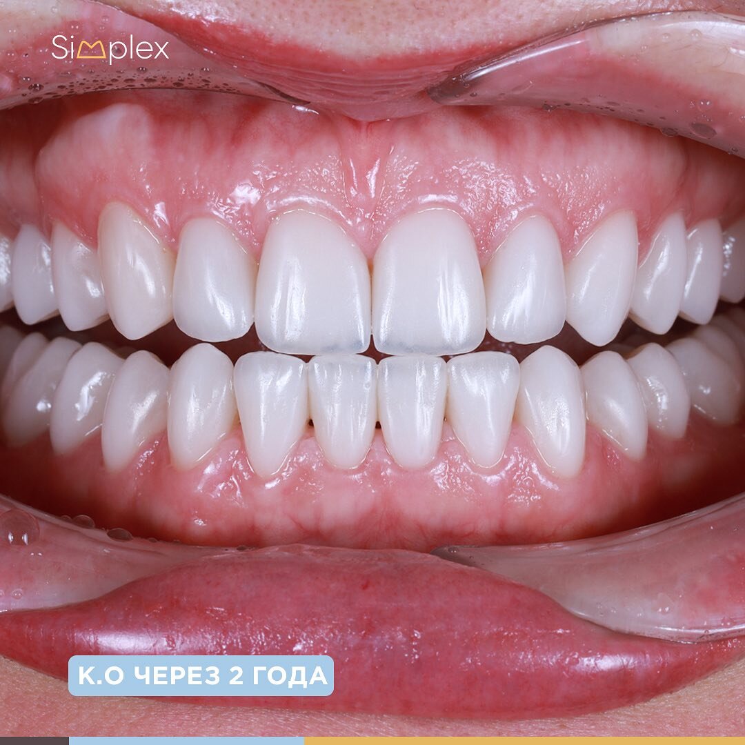 Керамические реставрации через 2 года после установки