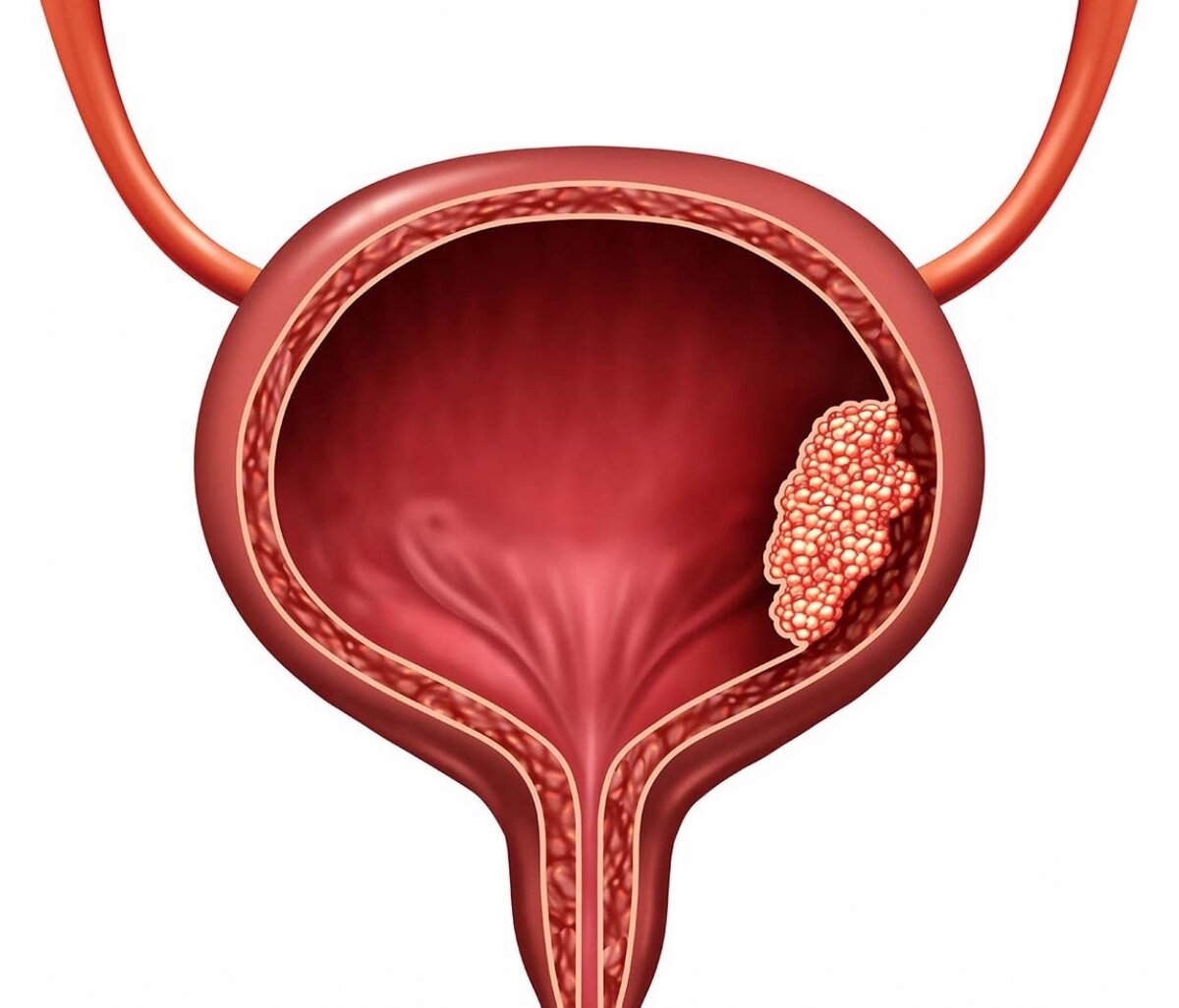 Опухоль мочевого пузыря – как не допустить, распознать и вылечить | Доктор  Соколов | Дзен