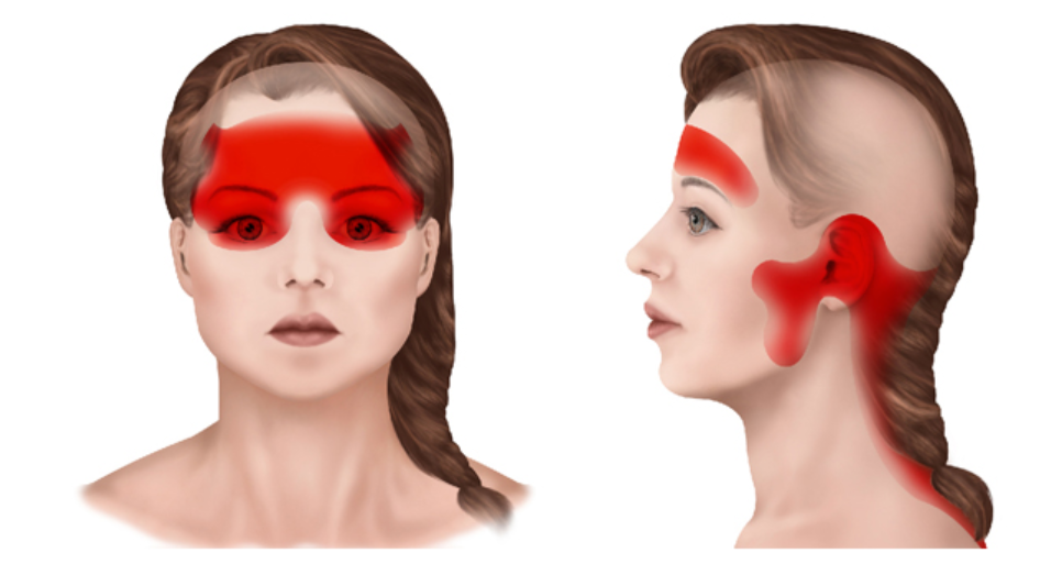 Локализация головной боли напряжения