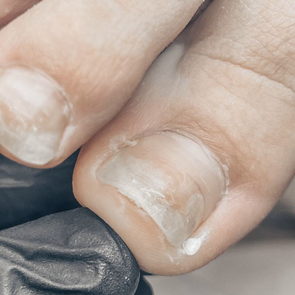 👩‍⚕️ Случай из практики: 25-летняя клиентка, страстная поклонница гель-лака, которая часто оставляет покрытие дольше рекомендуемого. Обратилась к нам за летним педикюром, естественно, с гель-лаком, чтобы ногти выглядели безупречно все лето!