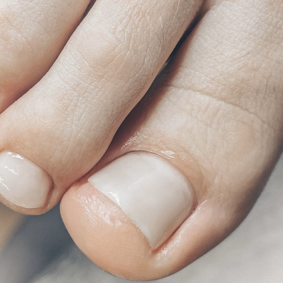 👩‍⚕️ Итоги консультации и приема:
- Выявлено отслаивание ногтевой пластины!
- Выполнен подологический педикюр с эстетической обработкой онихолизиса по запросу клиентки. Нанесено противогрибковое покрытие.   
- Рекомендовано избегать гель-лака на летний период для предотвращения дальнейших повреждений.
- Назначены уходовые средства и регулярные визиты к подологу каждые 4-6 недель.
- На осень запланирован курс по восстановлению ногтей.