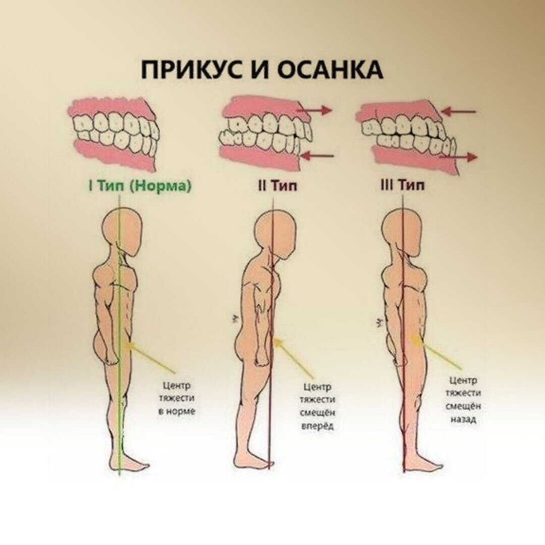 ⚡ Ваша голова &quot;уехала&quot; вперед, шея стала короче и выросла холка? 