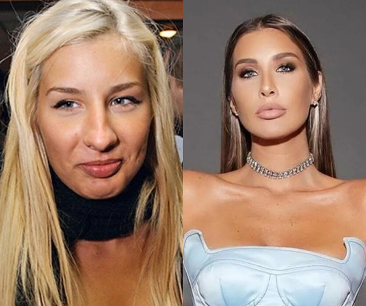 Топурия до пластики и после фото - ViktoriaFoto.ru