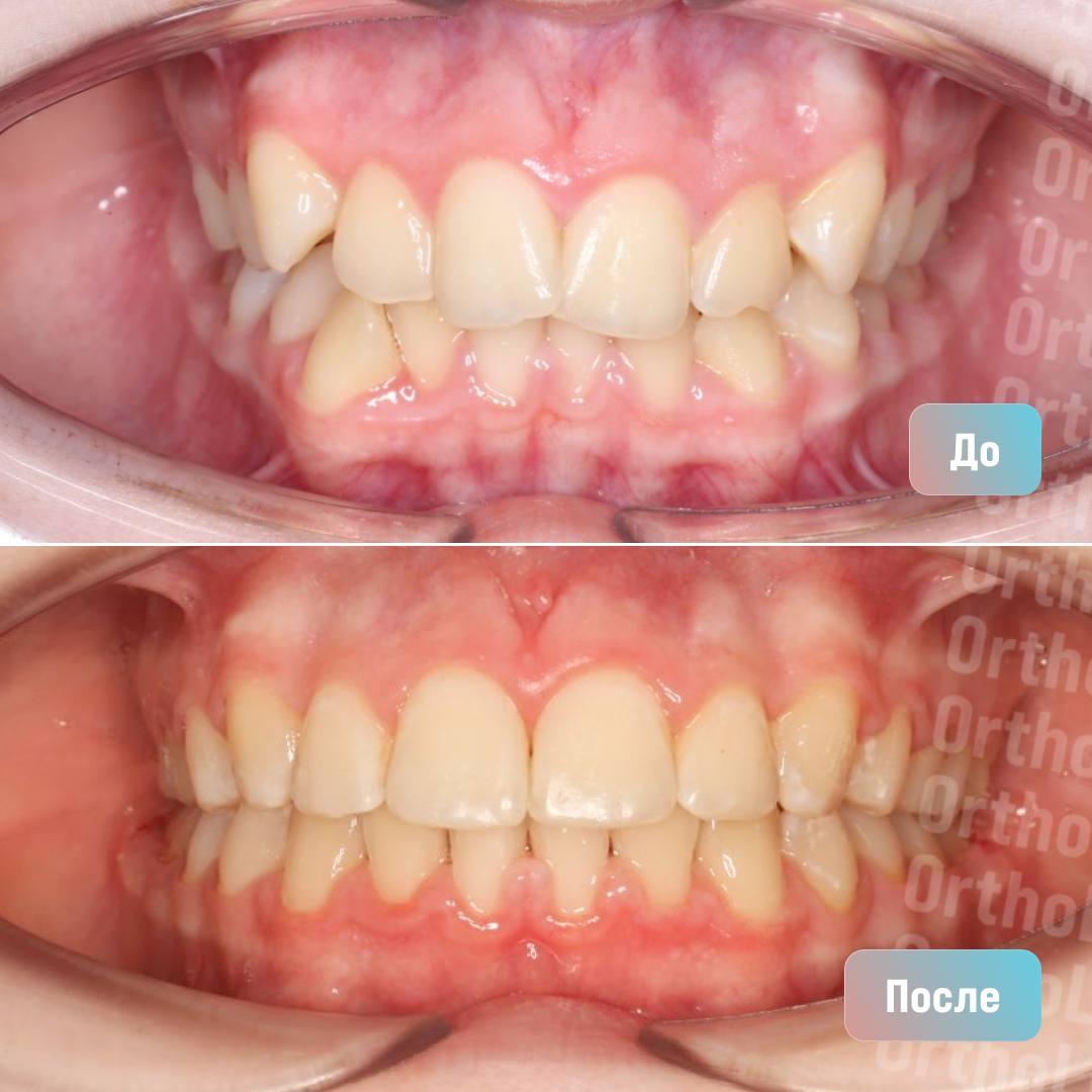 Прикус до и после лечения
