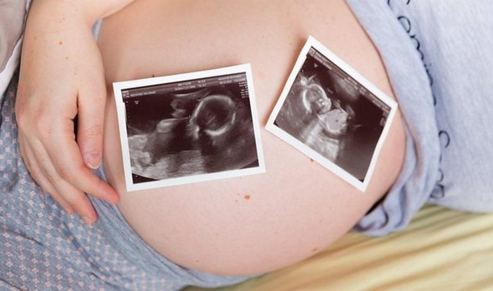  Беременность может быть и многоплодовой, а вот феномен сиамских близнецов считают патологией. / Фото:medaboutme.ru