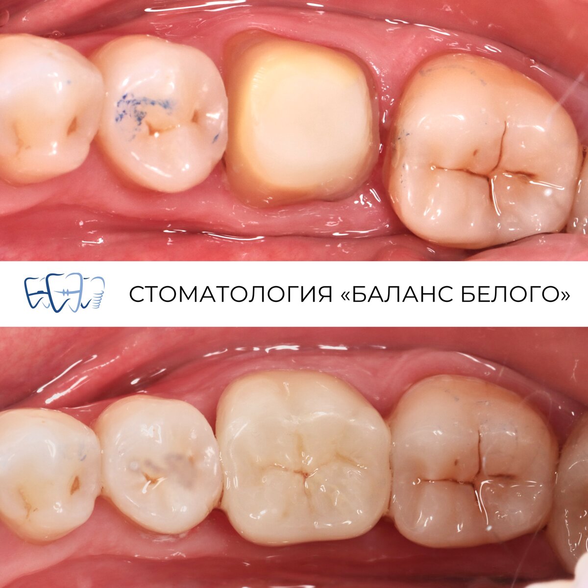 Установка коронок в Москве