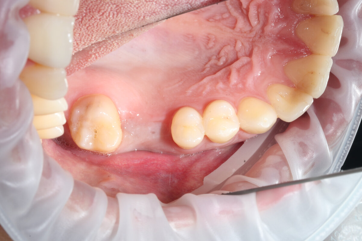 Имплантация зубов в Москве