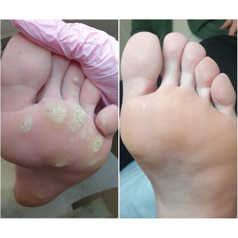 Обработка бородавок в Центре подологии, до и после.