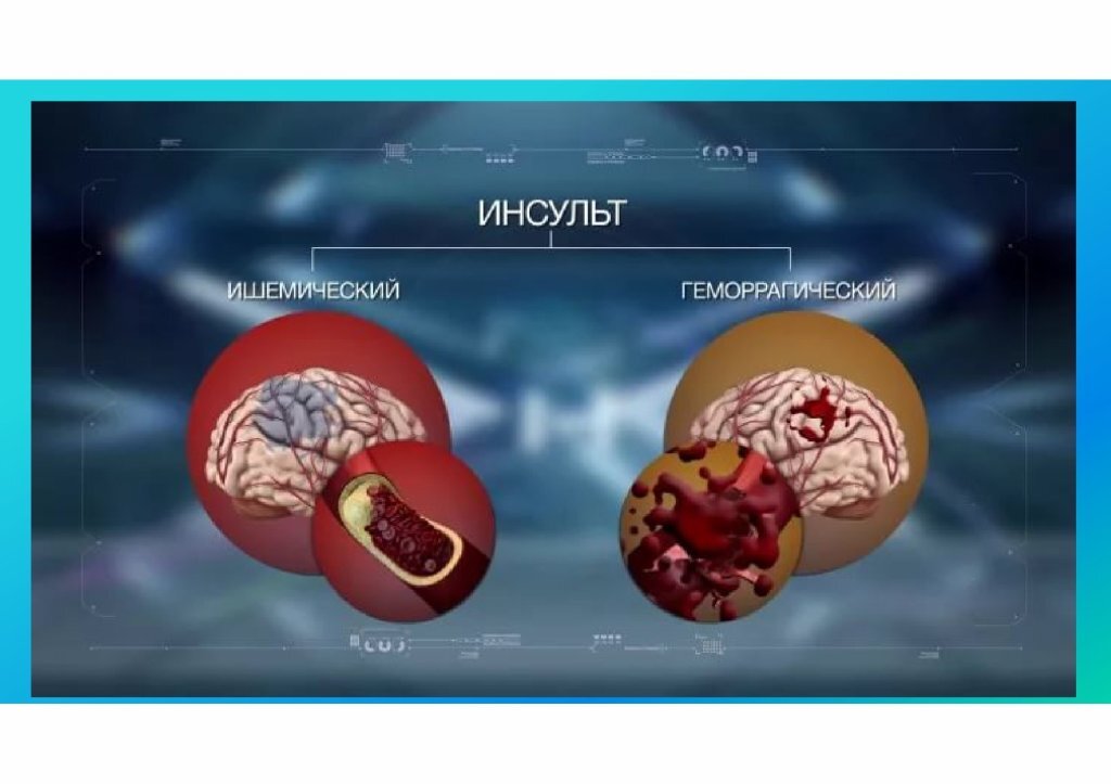 Инсульт — острое нарушение мозгового кровообращения, которое часто способствует инвалидизации пациента. Без своевременного лечения патология может значительно нарушать функции мозга и приводить к смерти.

Виды инсульта!  Прежде всего инсульт различают по причине возникновения.

Ишемический инсульт — нарушение мозгового кровообращения, вызванное закупоркой кровеносного сосуда и недостаточным кровоснабжением тканей (такую патологию называют ишемией — отсюда и название инсульта). Чем дольше отсутствует кровоснабжение, тем больше площадь поражения мозга.

Ишемический инсульт также называют инфарктом мозга. Инфаркт — это отмирание тканей из-за дефицита кислорода (ишемии). Он может произойти в любом органе.
Геморрагический инсульт — нарушение кровообращения, связанное с разрывом кровеносного сосуда и внутричерепным кровоизлиянием. При геморрагическом инсульте кровь изливается в субарахноидальное пространство, непосредственно ткань мозга или желудочки мозга.

При субарахноидальном кровоизлиянии кровь раздражает мозговые оболочки, развивается отёк и спазм сосудов головного мозга.

При внутримозговом кровоизлиянии последствия зависят от объёма излившейся крови. При большом объёме формируется внутримозговая гематома, которая сдавливает окружающую ткань мозга и вызывает смещение мозговых структур. При кровоизлиянии из мелких сосудов ткань мозга пропитывается кровью и нарушается функция соответствующих центров, расположенных в зоне кровоизлияния.

Прорыв крови в желудочки головного мозга вызывает нарушения терморегуляции и жизненно важных функций, например дыхания и кровообращения.