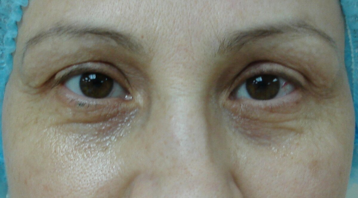До выполнения псевдоблефаропластики лазером