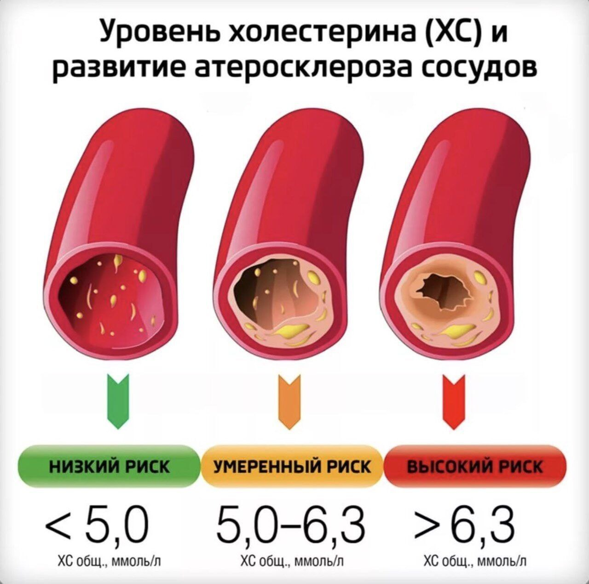 Если в крови слишком много, он может постепенно откладываться на внутренних стенках артерий, образуя так называемые холестериновые бляшки, в результате чего сосуды сужаются, снижается их эластичность. Этот процесс называется атеросклерозом. Он вызывает грозные последствия, среди которых ишемическая болезнь сердца и головного мозга, инфаркт миокарда, инсульты, закупорка сосудов тромбами. Холестерин не растворяется в крови.