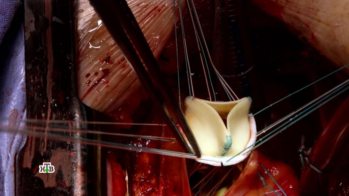    Органы животных  человеку: ксенотрансплантация и ее перспективы