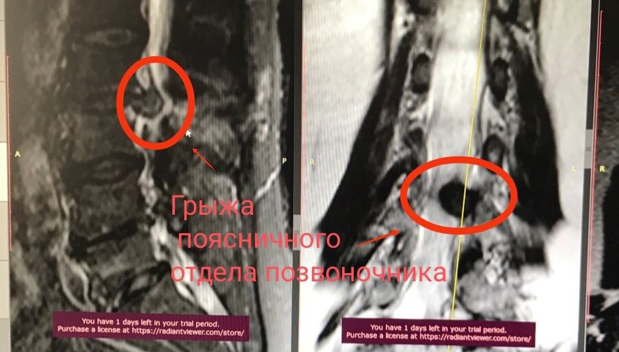 Как выглядит грыжа на снимке