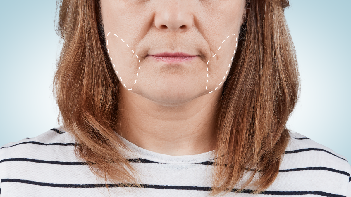 убираем брыли без пластики