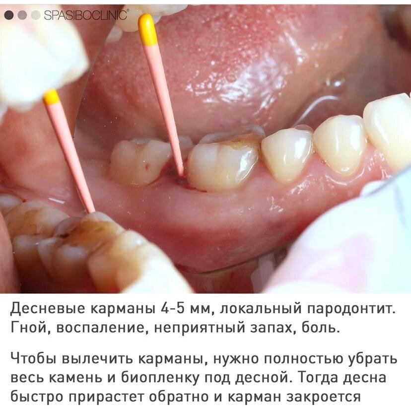 Пародонтальные карманы: от появления до лечения 🤭 | Здоровье с mandarin-sunlion.ru | Дзен