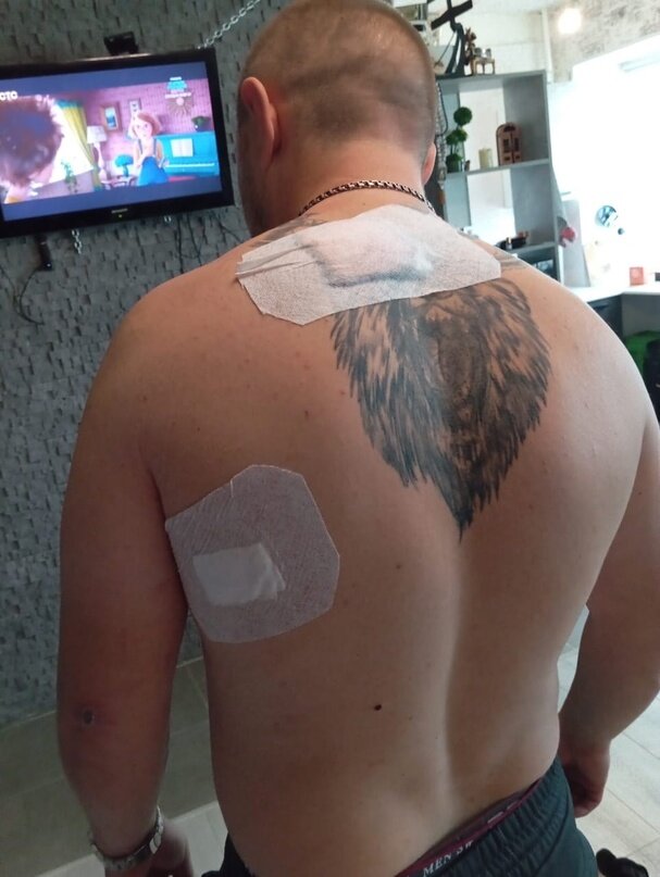 Раны Вячеслава. Источник: соцсети движения “Северный человек” в Орехово-Зуево 