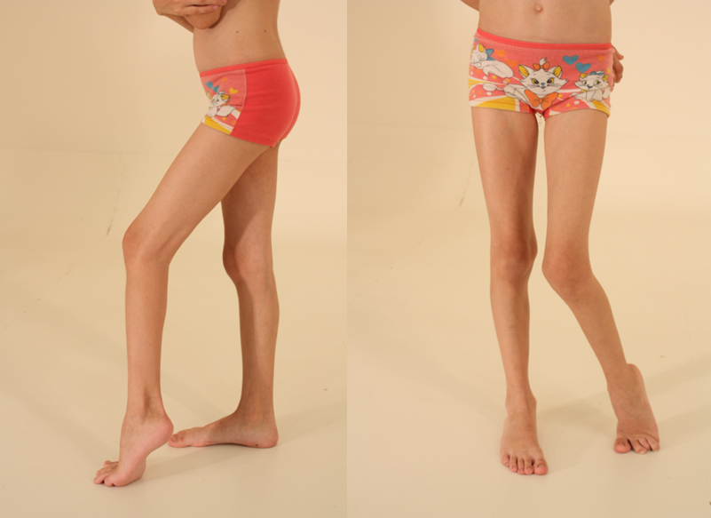  Торсионная деформация левой нижней конечности