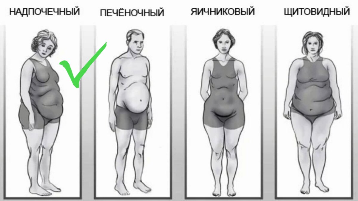 Типы ожирения 