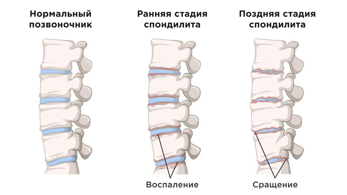 Как закалялась сталь: болезнь Бехтерева тогда и сейчас | Москва — столица  здоровья | Дзен