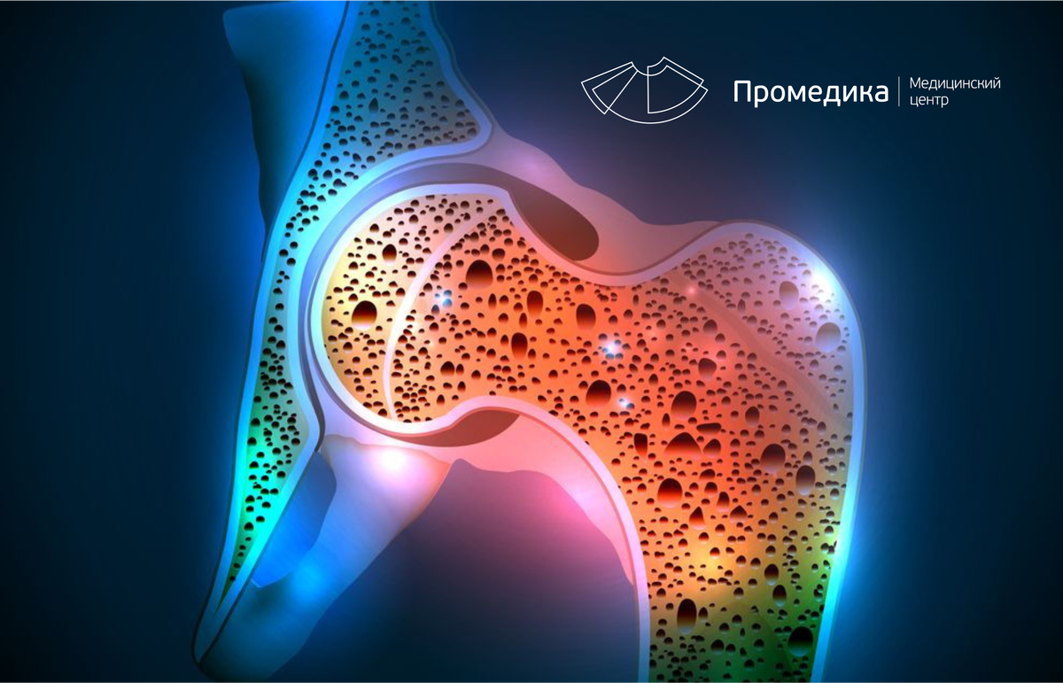 Остеопороз: детали, о которых молчит большинство