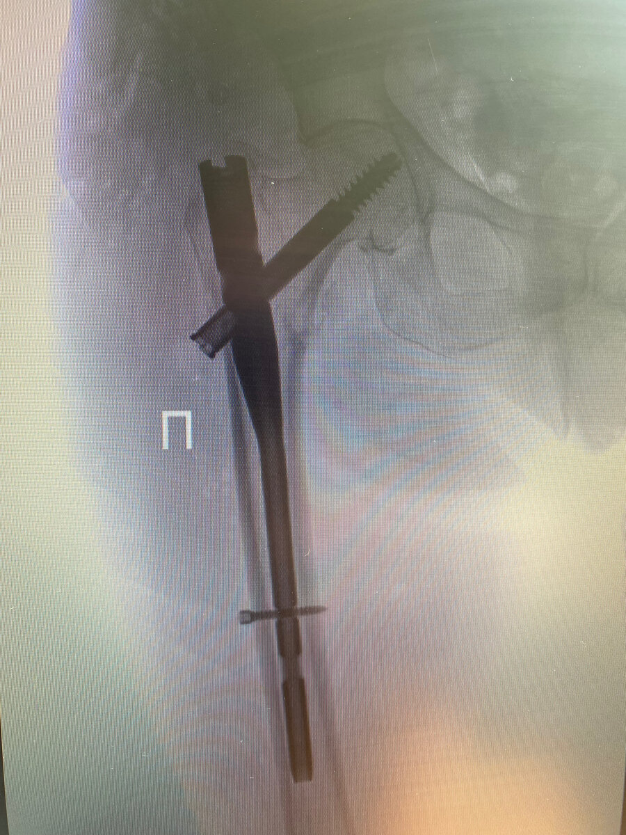 интрамедулярный стержневой остеосинтез бедренной кости у пациентки 82 лет