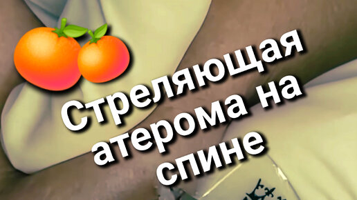 Стреляющая атерома на спине ЗАБРЫЗГАЛА косметолога 🍊 Плюс история из жизни!