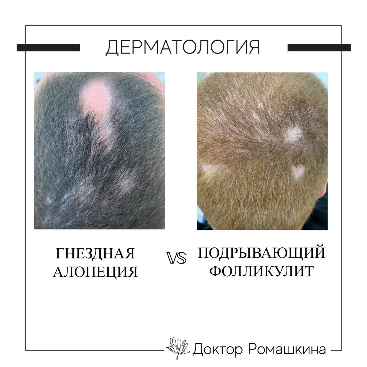 Волосяной фолликул картинка - Oboikomi.ru