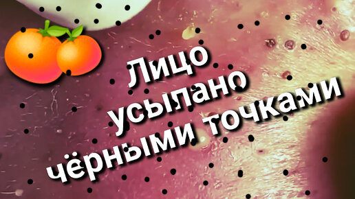 Всё лицо усыпано СМАЧНЫМИ чёрными точками 🍊 Такому не позавидуешь...