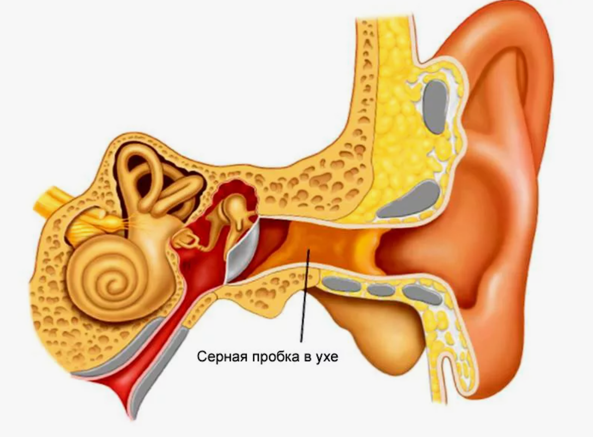 Снизился слух, болит ухо – как бороться с серными пробками? Полезные советы  | О здоровье: с медицинского на русский | Дзен