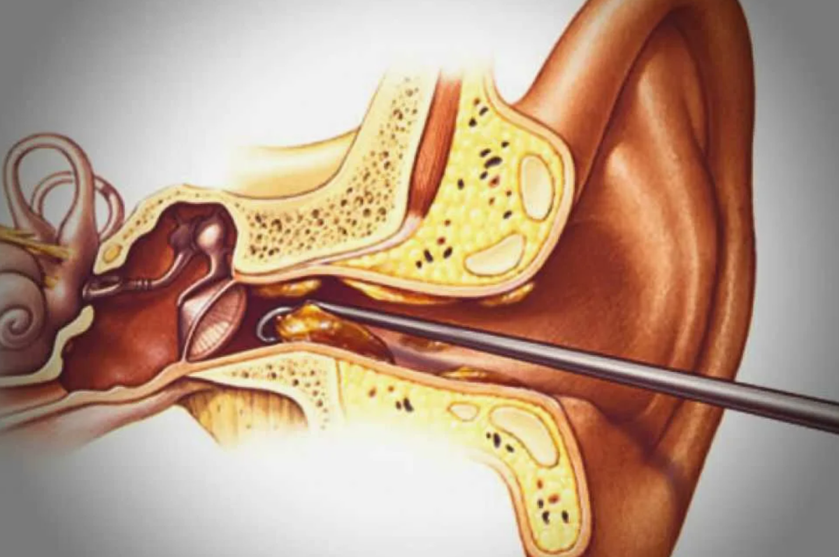 Снизился слух, болит ухо – как бороться с серными пробками? Полезные советы  | О здоровье: с медицинского на русский | Дзен