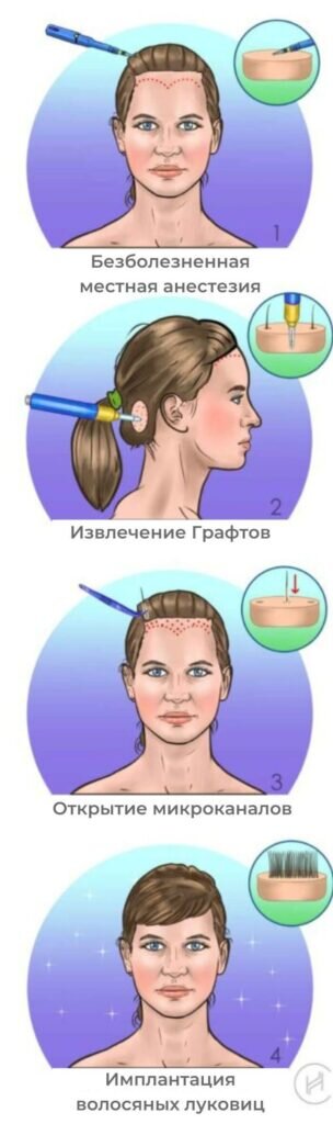 Пересадка Волос В Турции Цена Для Женщин