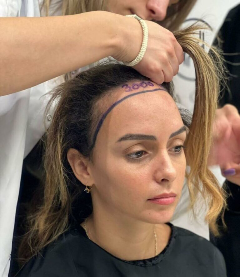 Пересадка Волос В Турции Цена Для Женщин