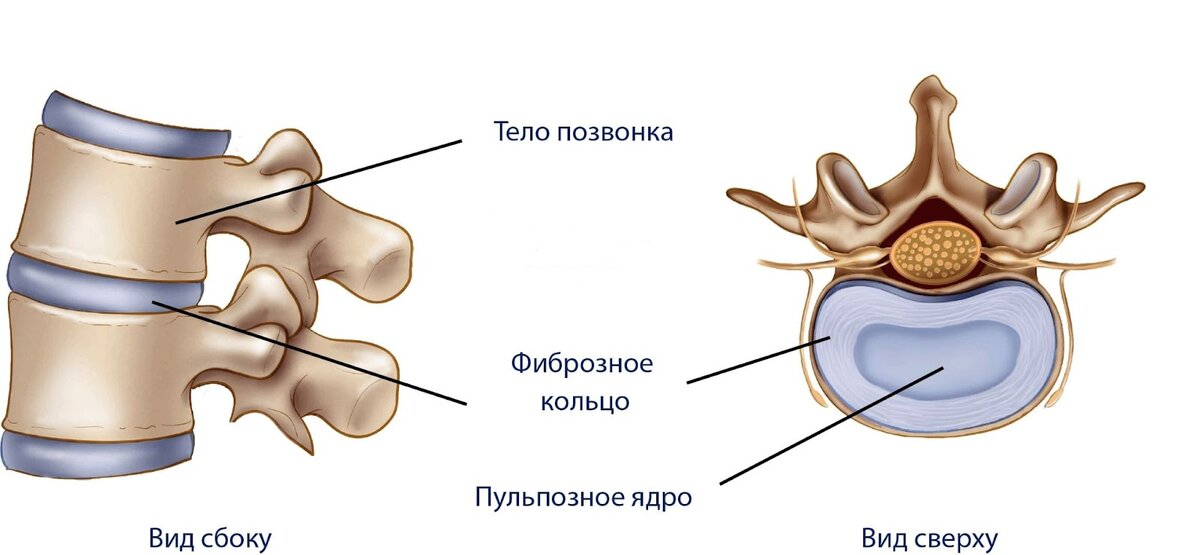 Межпозвонковая грыжа